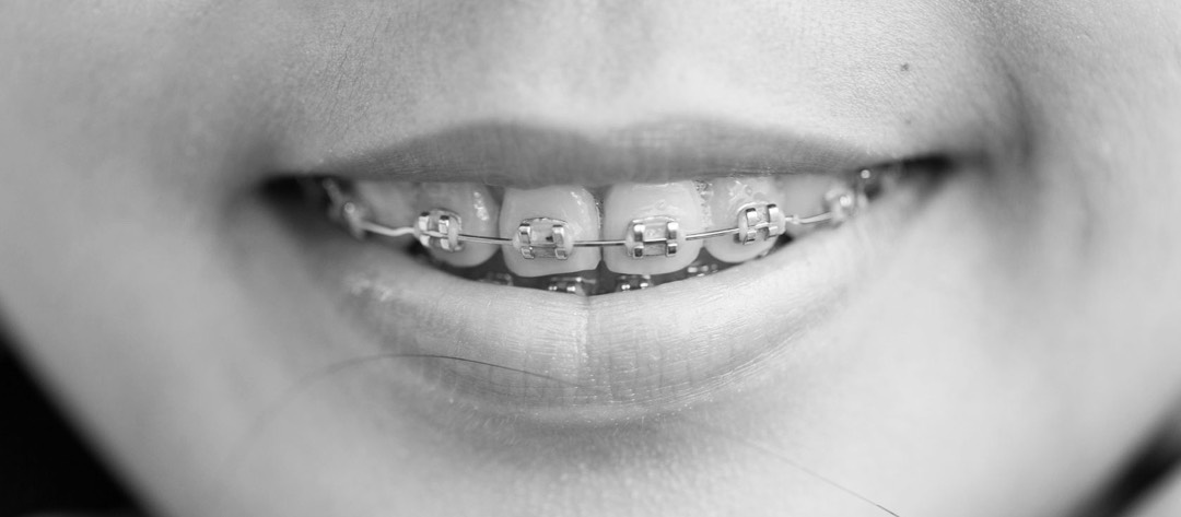 Bouche souriante avec bagues othodontiques